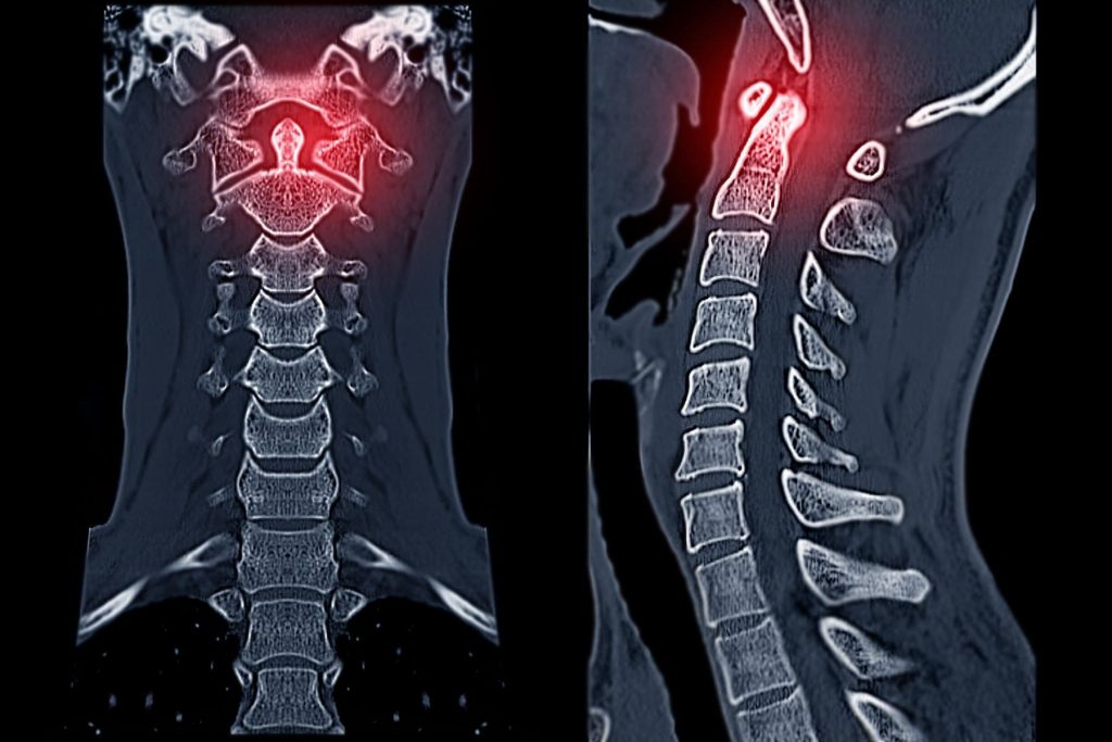 Scanner montrant une hernie cervicale avec compression du disque intervertébral